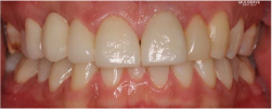 Teeth After Ceramic Veneers - Mulgrave Dental Group 