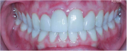 After Results of Teeth with Ceramic Veneers on Top 4 - Mulgrave Dental Group