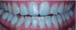 Before Shot of Teeth Prior to Ceramic Veneers on Top 4 - Mulgrave Dental Group