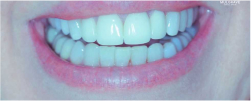 After Aligner Orthodontics Treatment at Mulgrave Dental Group