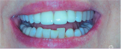 Before Clear aligner orthodontics treatment at Mulgrave Dental Group