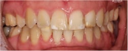 Patient's teeth After Braces - Braces Before & After - Mulgrave Dental Group 