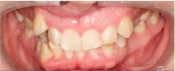 Patient's teeth Before Braces - Braces Before & After - Mulgrave Dental Group