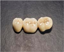 3 Teeth on Table Showing Example of Crowns and Bridges - Mulgrave Dental Group