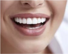 Woman's Smile Showing Straight, Bright White Teeth after Dental Bonding - Mulgrave Dental Group