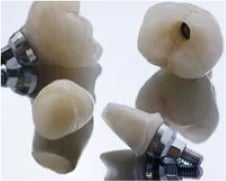 Close Up of 4 Dental Implants on Tray - Mulgrave Dental Group