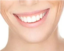 Close up of Gum Line on Patient Showing Gummy Smile Fix - Mulgrave Dental Group