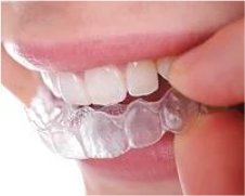 Close Up of Teeth While Removing Clear Aligner - Mulgrave Dental Group