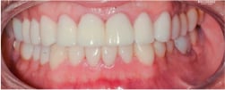 After Results of Ceramic Veneers and Ceramic Crowns on Patient - Mulgrave Dental Group
