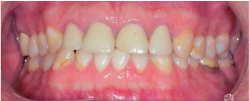 Before Shot of Ceramic Veneers and Ceramic Crowns on Patient - Mulgrave Dental Group