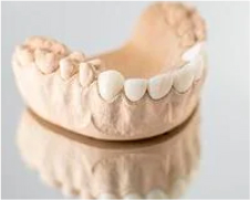 Example of Porcelain Veneers on Mold Model - Mulgrave Dental Group
