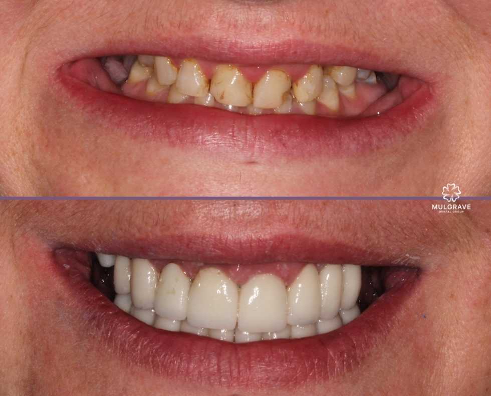 Top and bottom teeth veneers by Mulgrave Dental Group Melbourne Australia Top and bottom teeth veneers by Mulgrave Dental Group Melbourne Australia