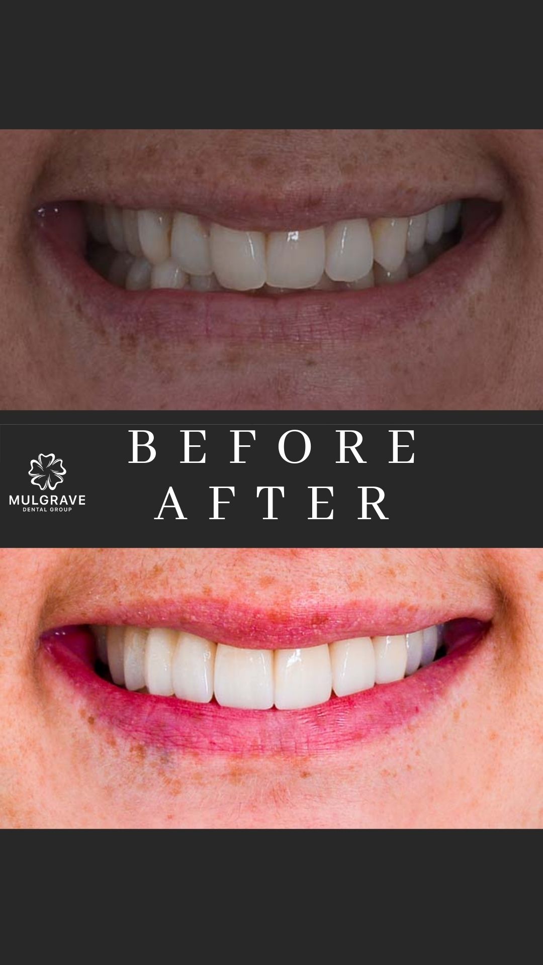 Veneers Melbourne Before and After VIC001-1