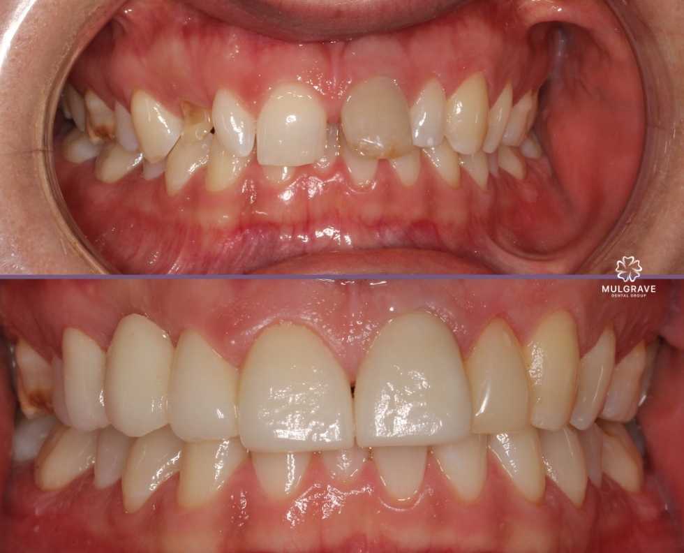 Veneers on top teeth by Mulgrave Dental Group Melbourne Australia Veneers on top teeth by Mulgrave Dental Group Melbourne Australia