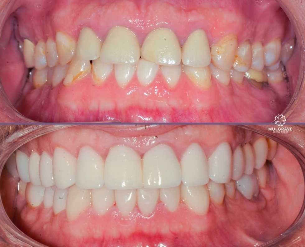 Venners and dental crown by Mulgrave Dental Group Melbourne Australia Venners and dental crown by Mulgrave Dental Group Melbourne Australia