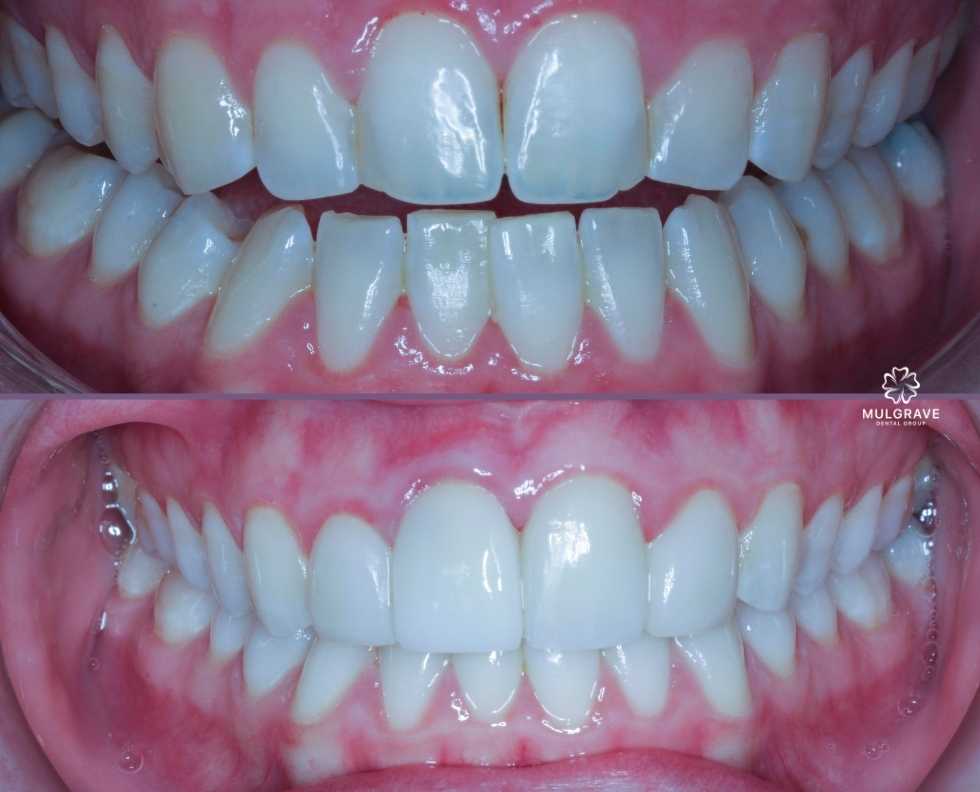 ceramic veneers by Mulgrave Dental Group Melbourne Australia ceramic veneers by Mulgrave Dental Group Melbourne Australia