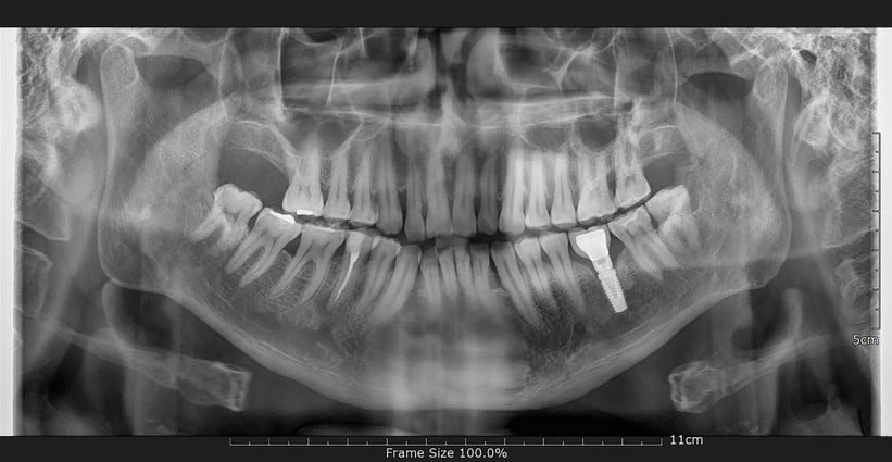 a radiograph of a single tooth dental implant