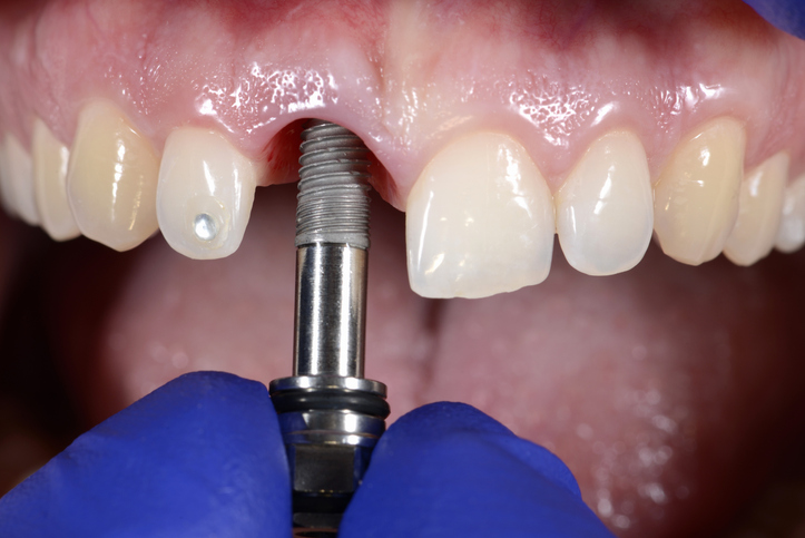 dental implant placement dental implant placement
