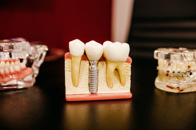 Why You Need To Crown Root Canal Treated Teeth