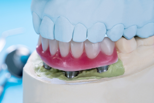 Implant-Supported Dentures vs. Traditional Dentures