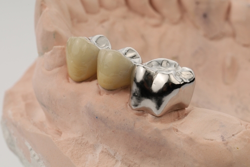 porcelain v metal crowns