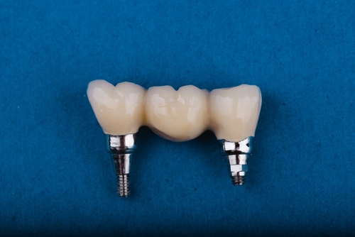 dental crowns v bridges