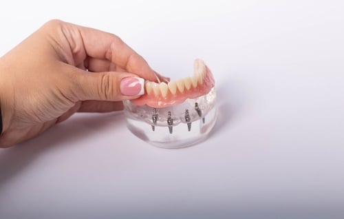 4 Advantages of All-On-Four Dental Implants vs Traditional Dentures