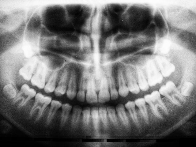 A Guide To Wisdom Teeth Removal Aftermath